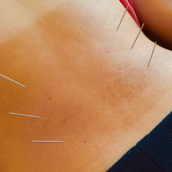 Back needles