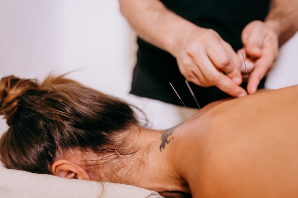 person receiving acupuncture on their back and neck